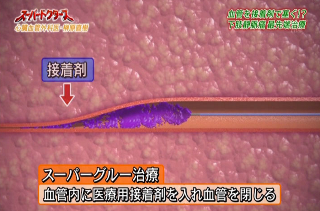 TBS「スーパードクターズ」で取り上げられた驚きの日帰り手術「スーパーグルー治療」とは？！ | mukumi